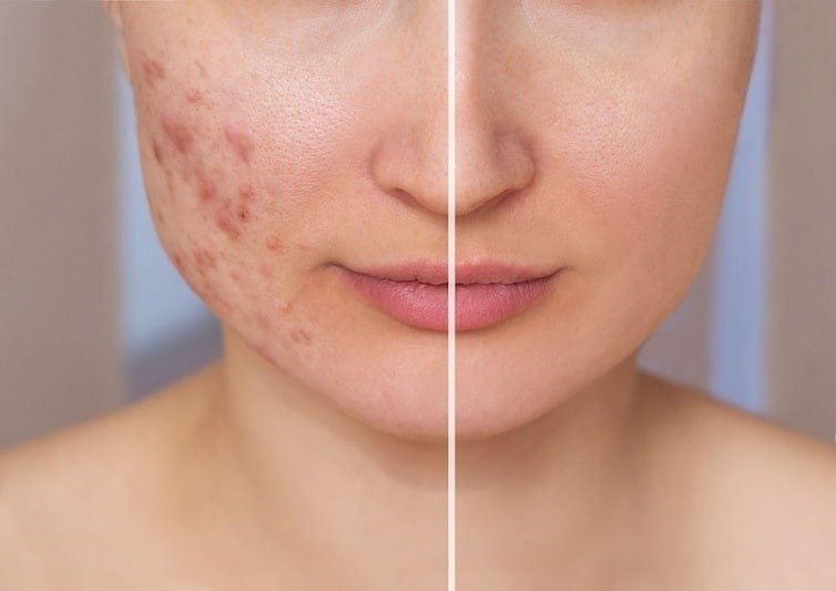 How to Choose the Right Acne Treatment for Your Skin Type