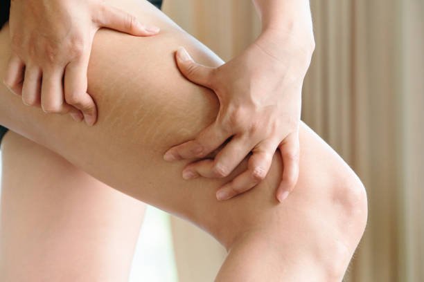 Is Stretch Mark Removal Suitable for All Skin Types
