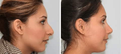 Rhinoplasty in Islamabad