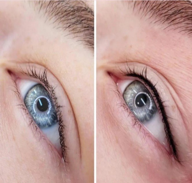 Tattoo Laser Removal
