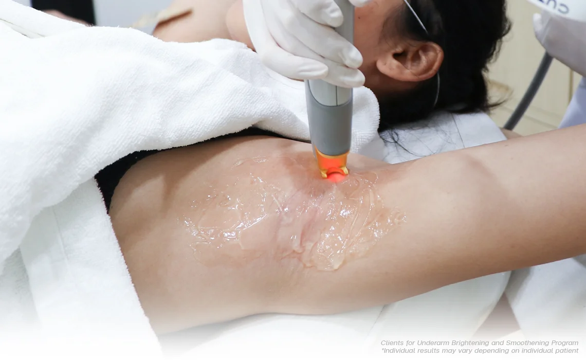 Underarm Whitening Treatments in Dubai