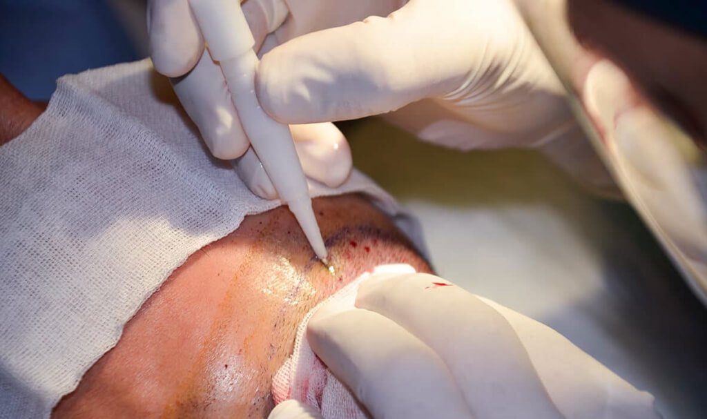 Hair Transplant in Dubai