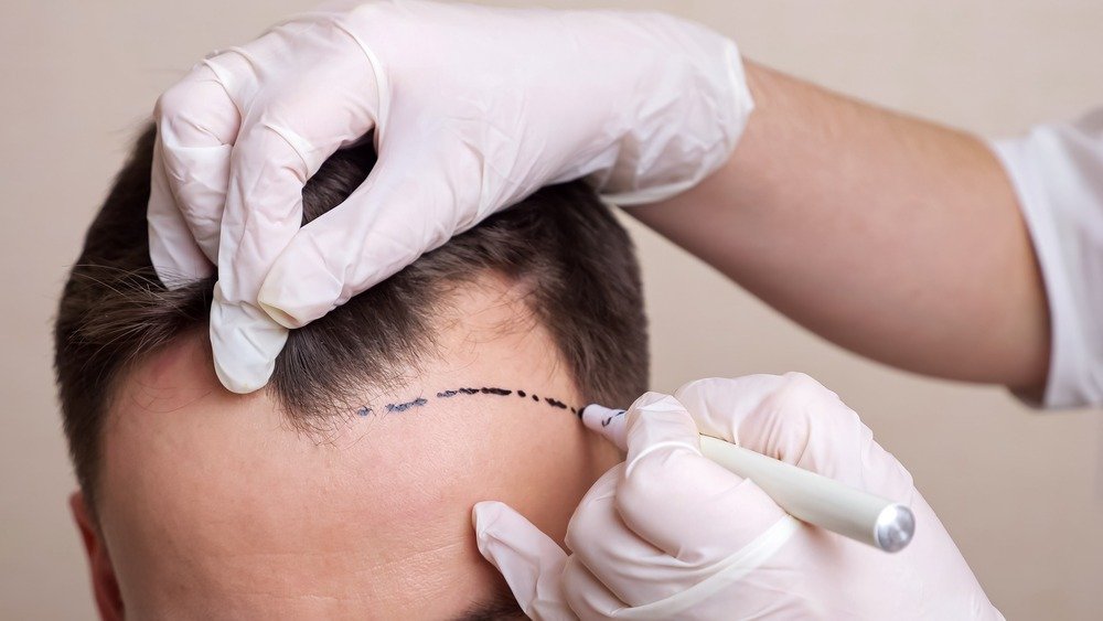 Hair Transplant In Dubai