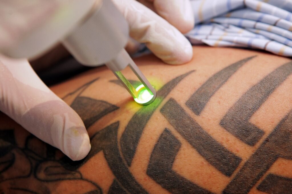 laser tattoo removal in Islamabad-