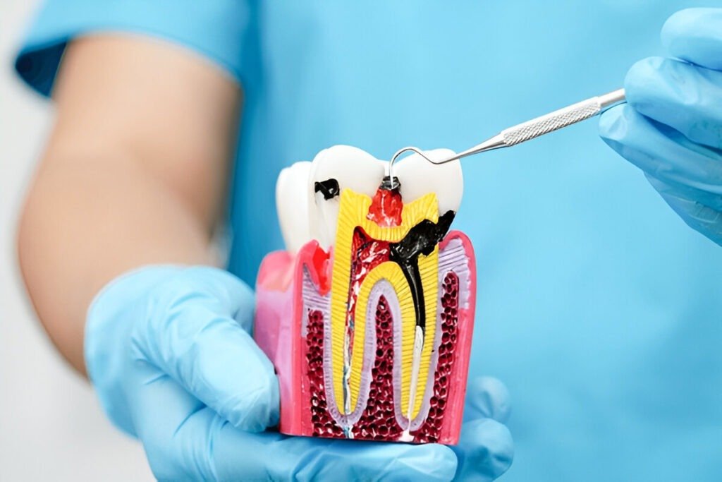 Same Day Root Canal Treatment: What to Expect and How It Works