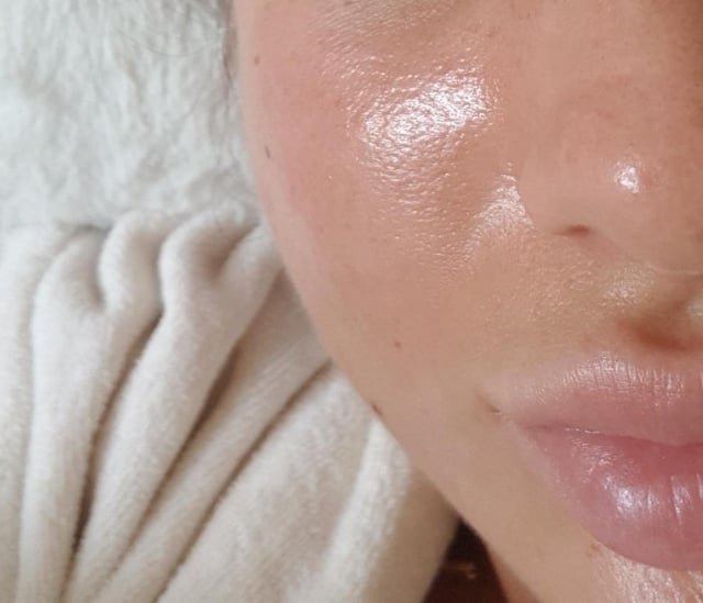 Large Pores Treatment in Dubai