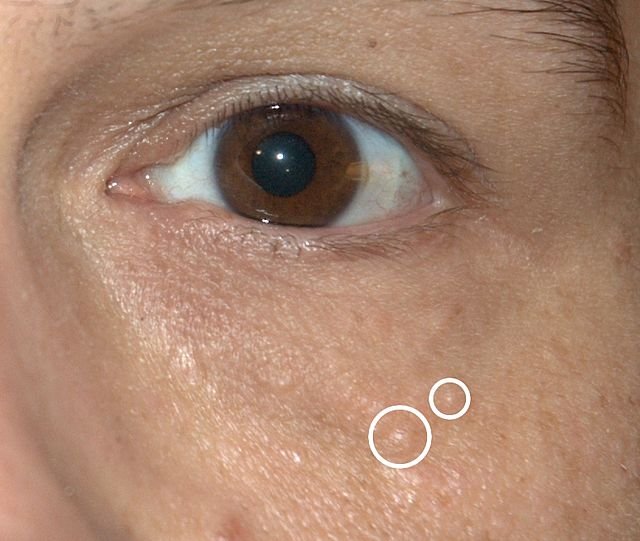 Milia Treatments