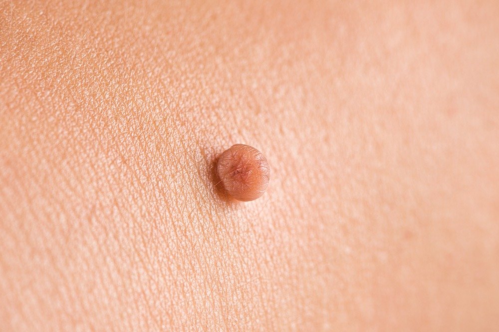 Skin Tag Removal in Dubai