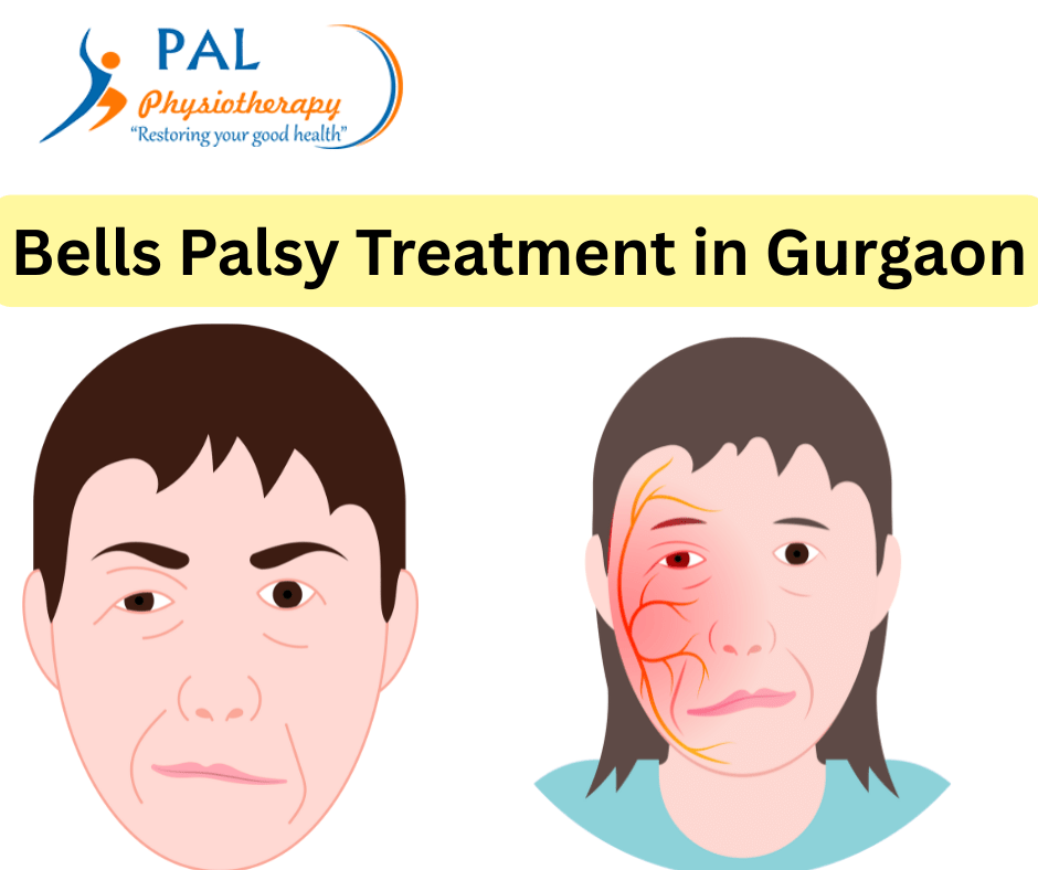 Bells Palsy Treatment in Gurgaon