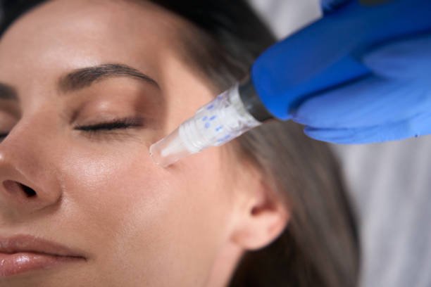 Derma pen