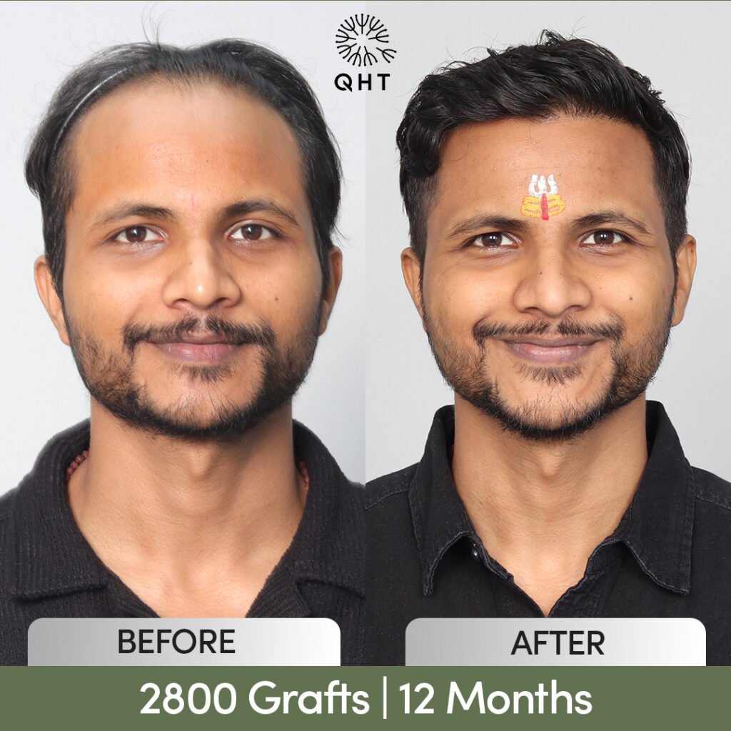 Best hair transplant clinic in India