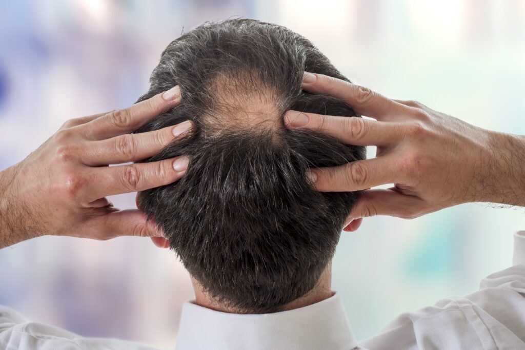 Does Finasteride for Hair Loss Work on Crown