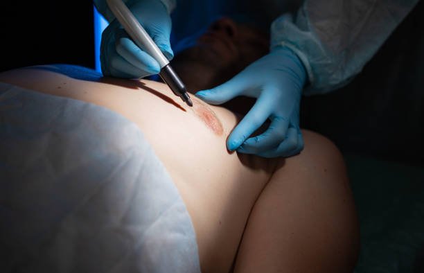Gynecomastia Surgery in Riyadh