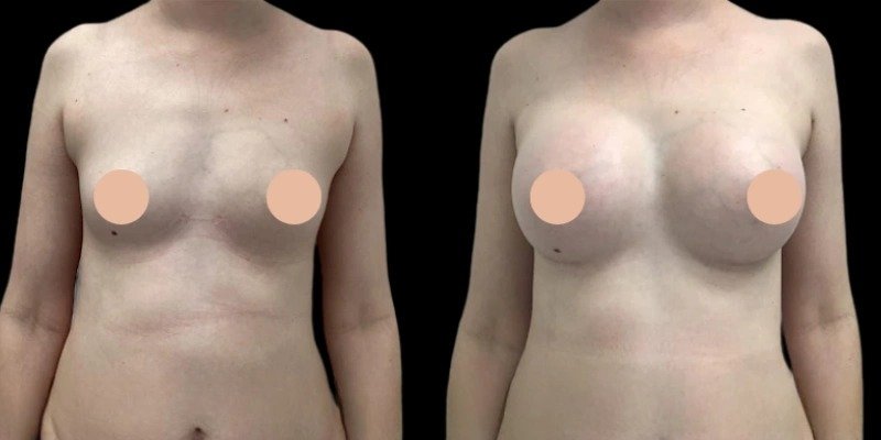 Breast Augmentation in Dubai