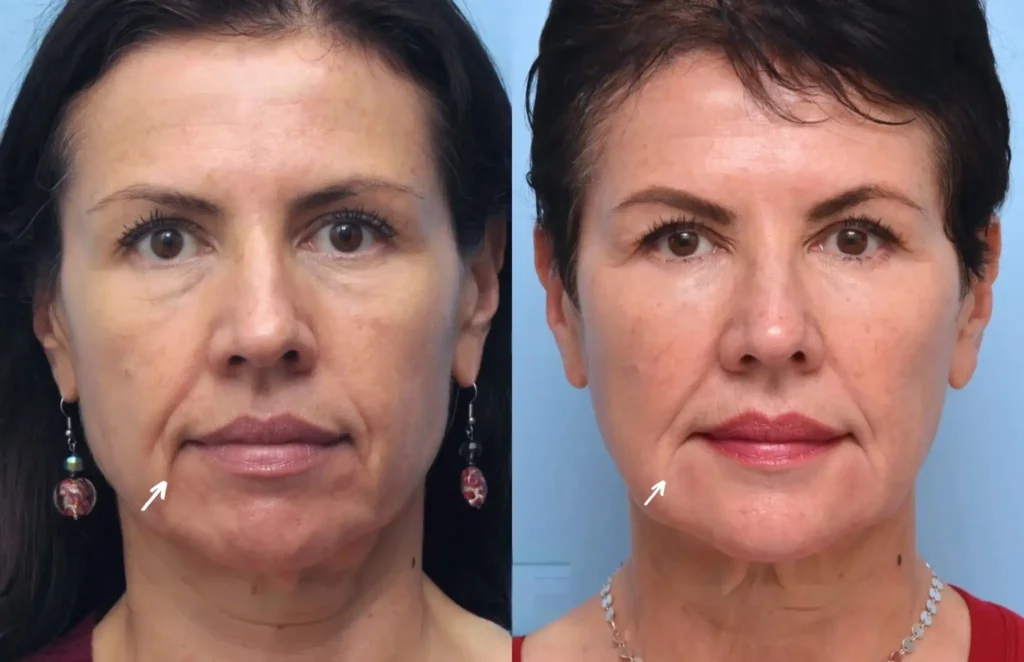 Why the Best Doctors in Dubai Trust Botox for Anti-Aging Treatments