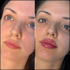 Non-Surgical Solution: Best Aesthetic Clinic in dubai for Fillers 40 H5 lip fillers 1 1 2