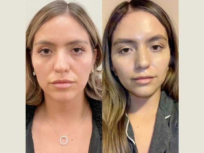 Thread Lift in Dubai: What to Expect from the Procedure