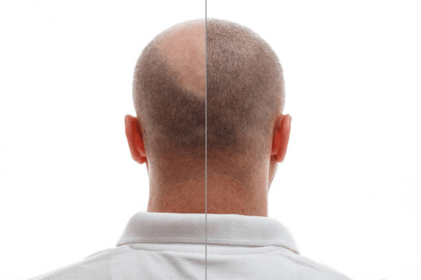Hair Transplant in Riyadh