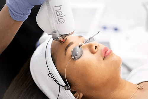 Halo Laser Resurfacing for a Fresh Look