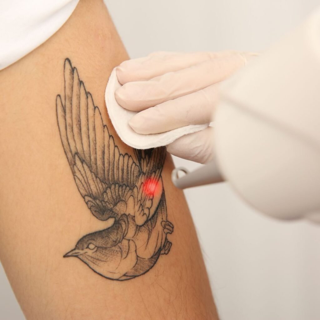 Laser Tattoo Removal in Dubai