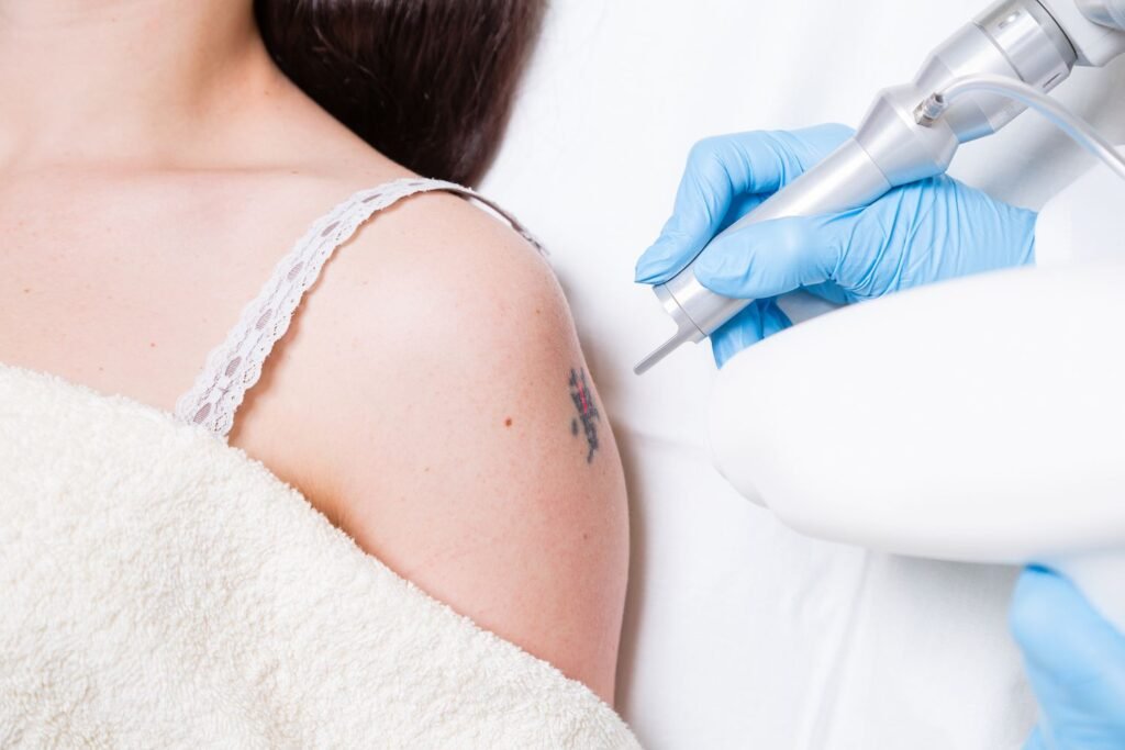 Laser Tattoo Removal in Dubai