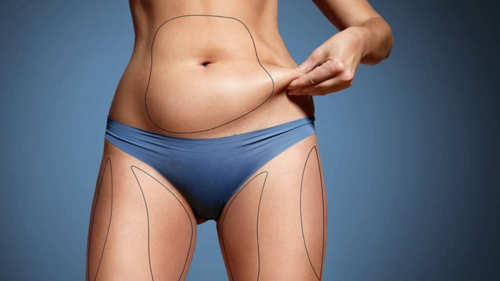 Liposuction in Dubai