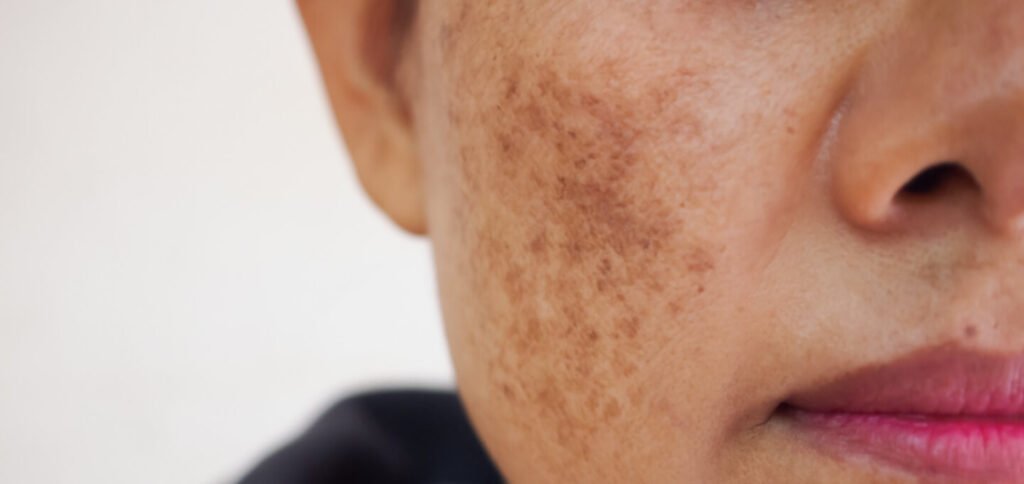 Melasma Treatment in Islamabadd