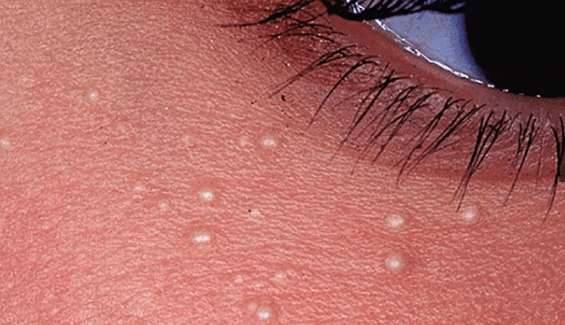 skin tag removal