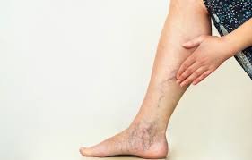 Spider Veins Treatment Made Simple