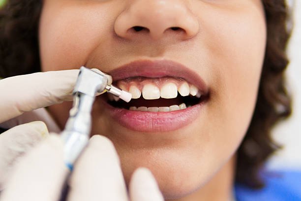 Teeth Cleaning and Polishing