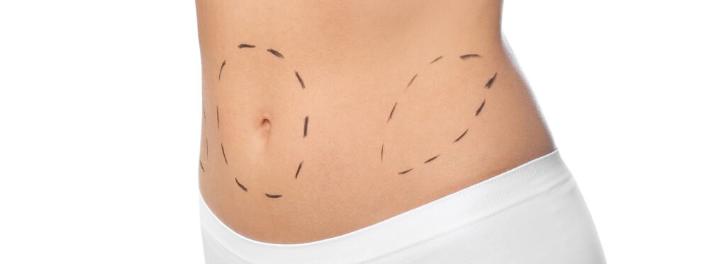 Tummy Tuck in Dubai