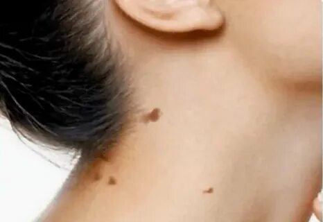 What Are the Benefits of Skin Tag Removal