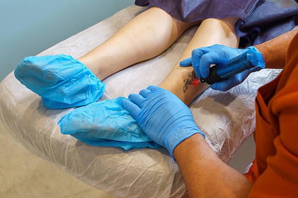 What Makes Laser Tattoo Removal Popular