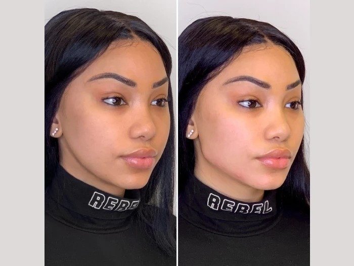 Before and After Thread Lift: Real Results from the Best Plastic Surgeons in Dubai