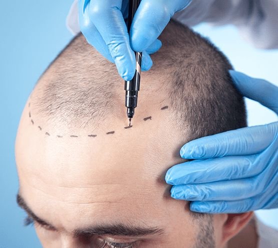 hair transplant in Riyadh