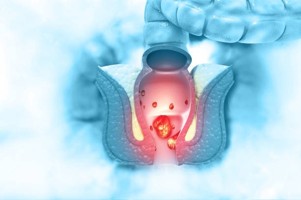 Hemorrhoid Treatement in Riyadh
