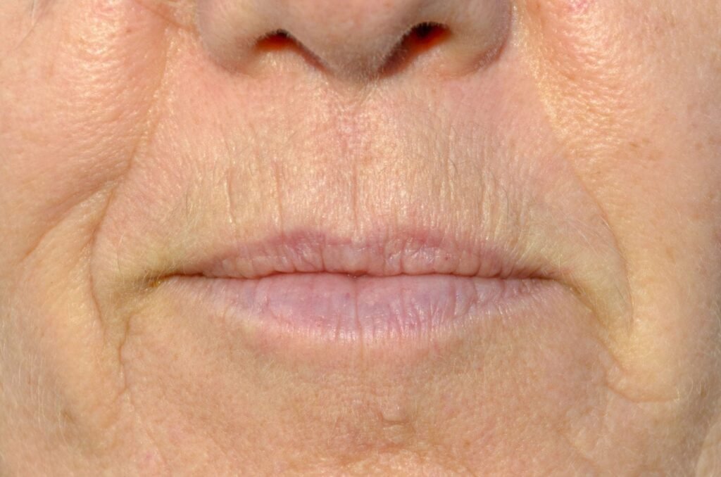 Smoker’s Lips Treatment in Dubai.