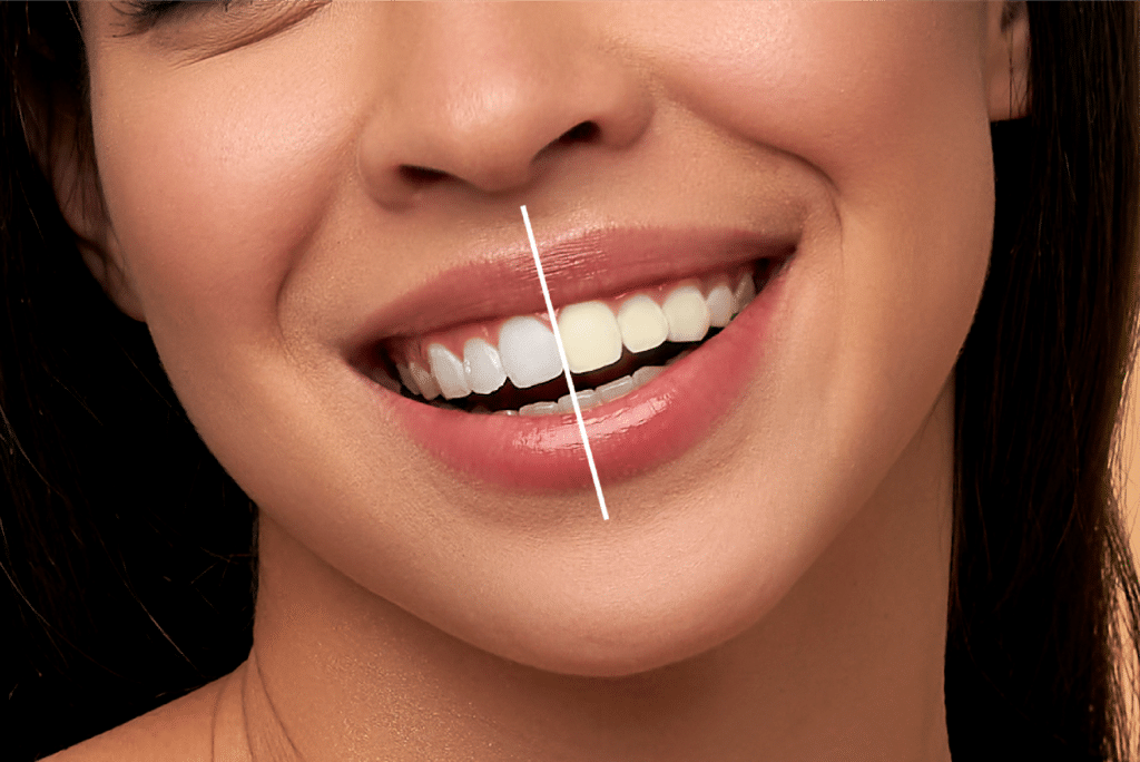 teeth whitening in riyadh