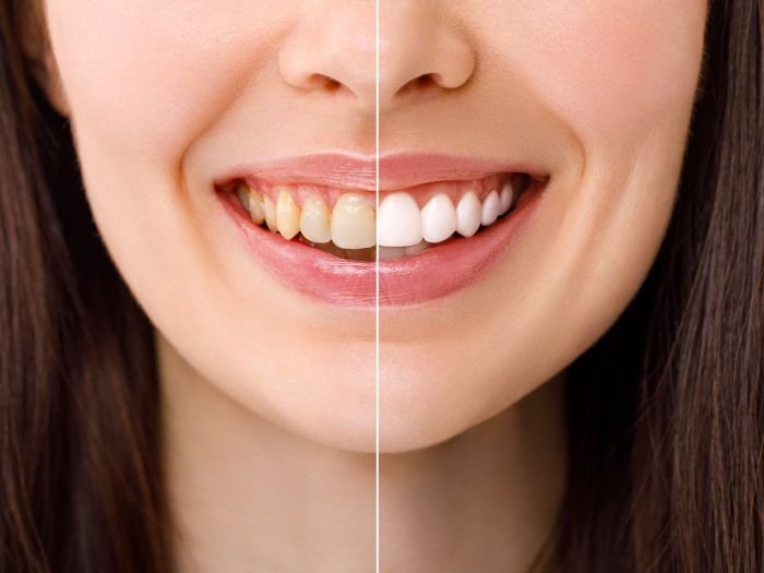 teeth whitening in riyadh