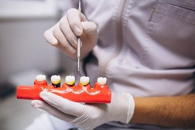 cheap dental crowns