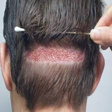 زراعة الشعر