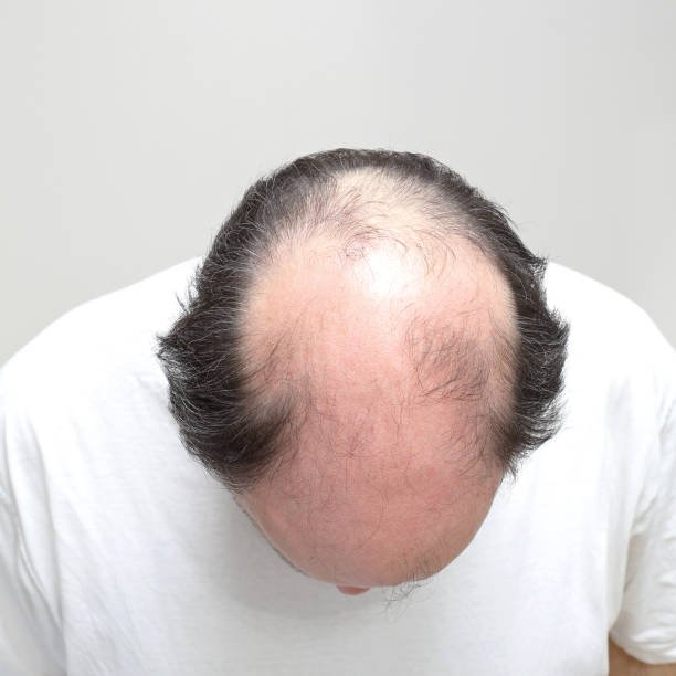 ما هي فوائد زراعة الشعر التاجي ؟