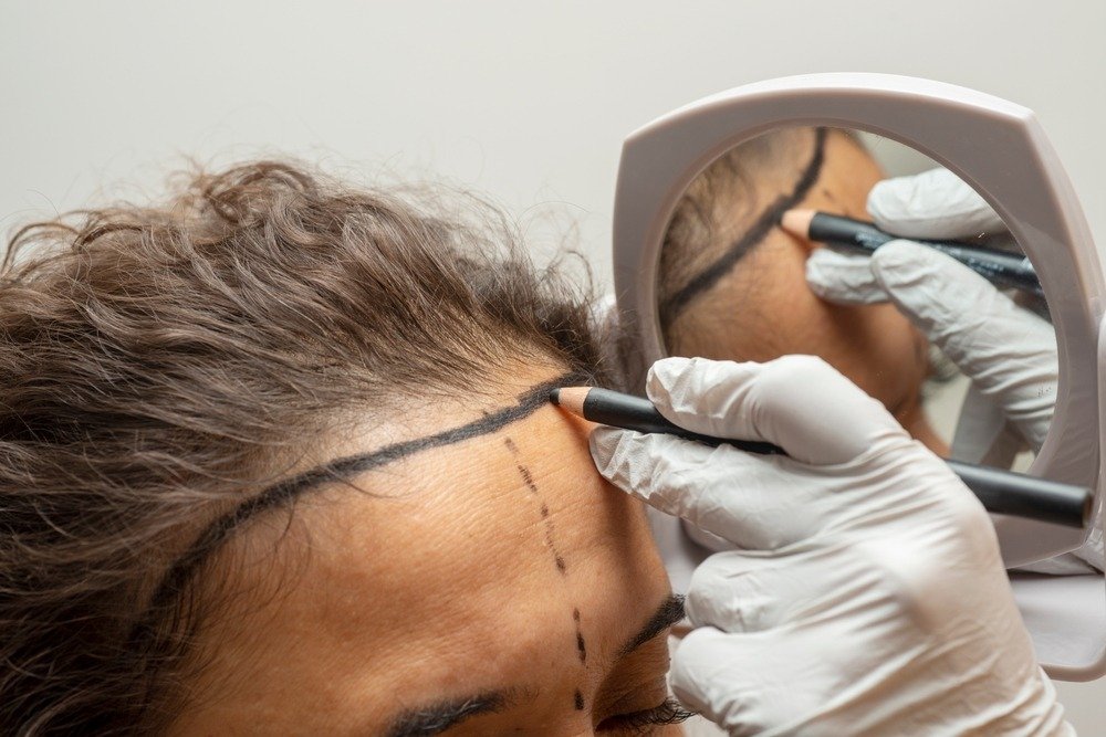 Hair Transplant in Dubai