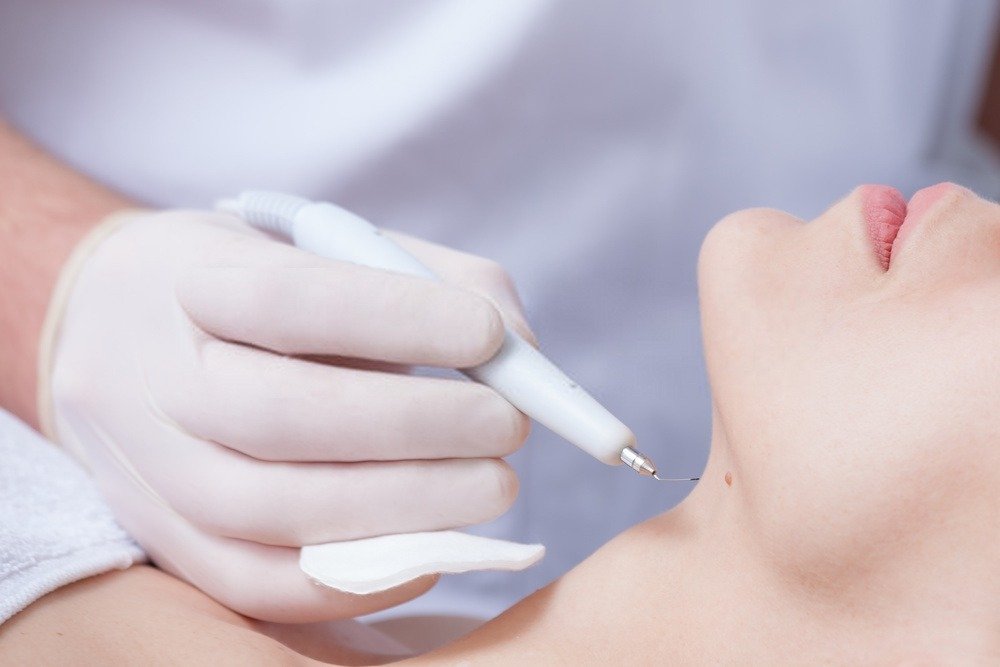 Discover the Latest Advanced Methods in Warts Removal Surgery