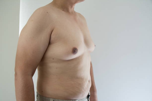 Gynecomastia treatment without surgery