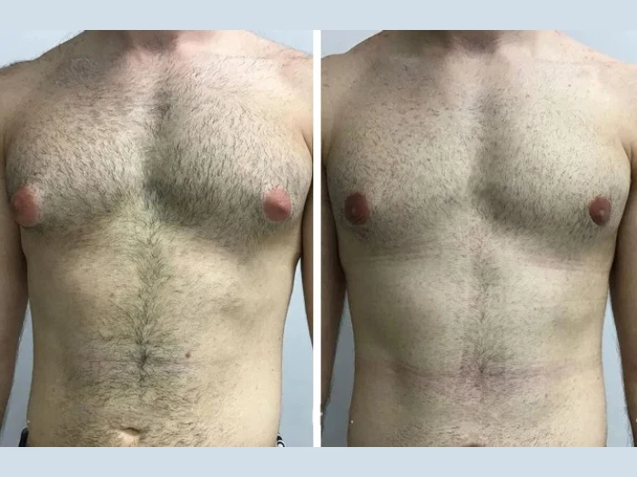 Teen Gynecomastia: How the Best Doctors in Dubai Handle Sensitive Cases