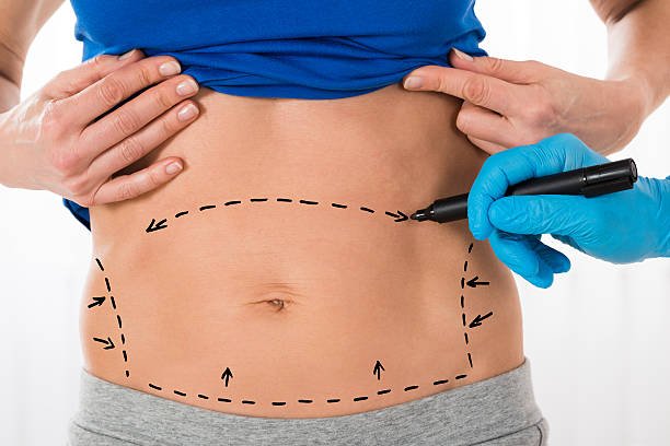 How Liposuction Boosts Confidence