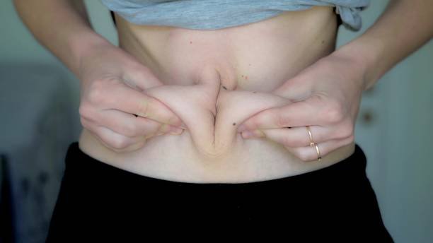How Mini Abdominoplasty Shapes the Waist