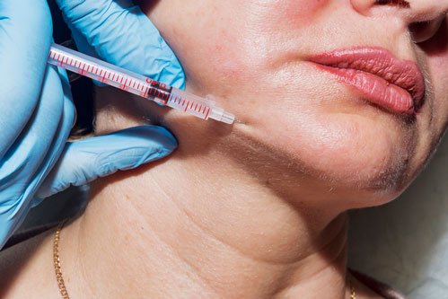 Instant Definition with Jawline Filler Treatments
