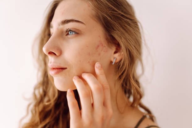 Is Acne Treatment in Abu Dhabi Worth It
